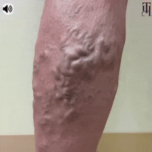 Ulei Antiinflamator cu Ghimbir pentru Picioare Amortite si Varici